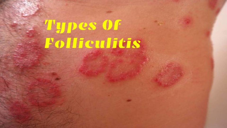 Folliculitis What Is Folliculitis? Its Symptoms, Causes, And More