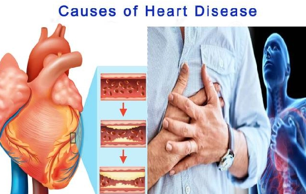 What are the Causes of Heart Disease?