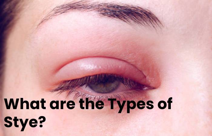 Stye - Definition, Symptoms, Types, Remedies, and More