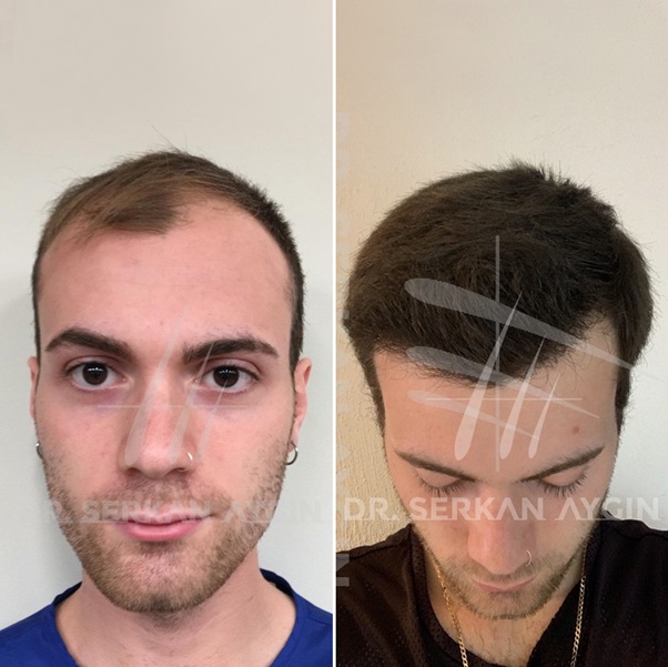 hair transplants