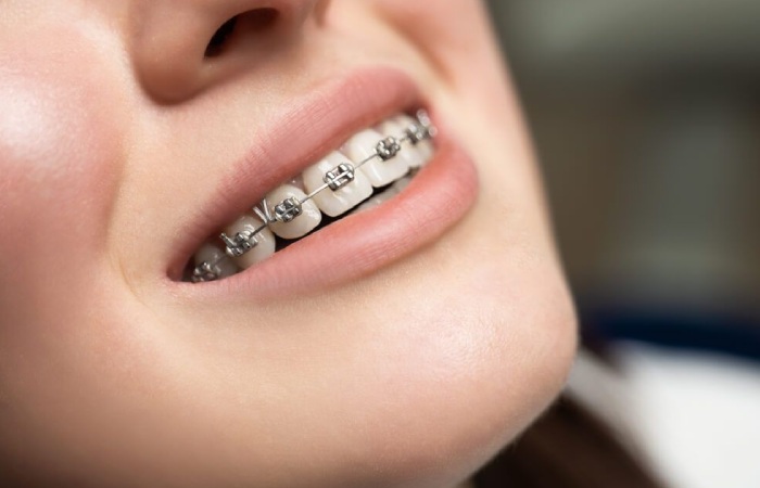 Braces Write for Us