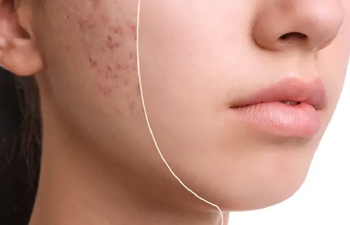Acne (Pimple) Treatment Methods