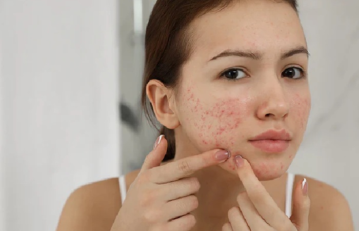 Acne Pimple Write for Us