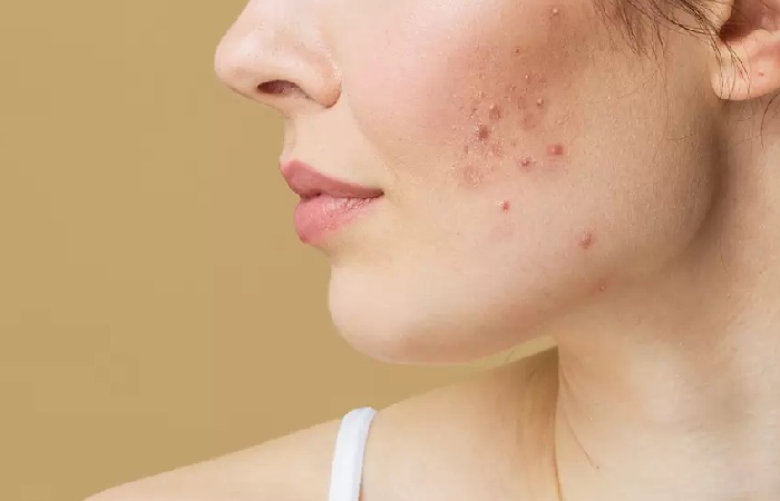 Acne Write for Us