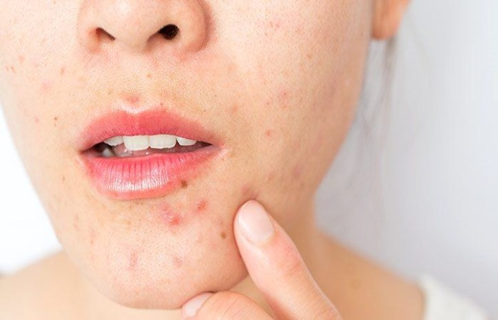 Causes of Acne
