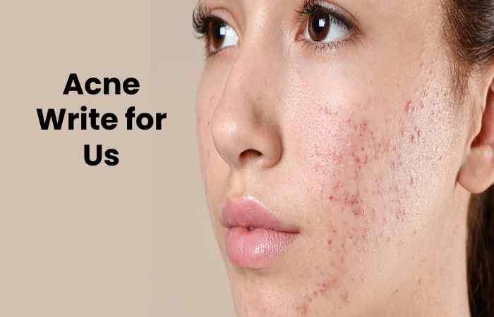 Acne Write for Us