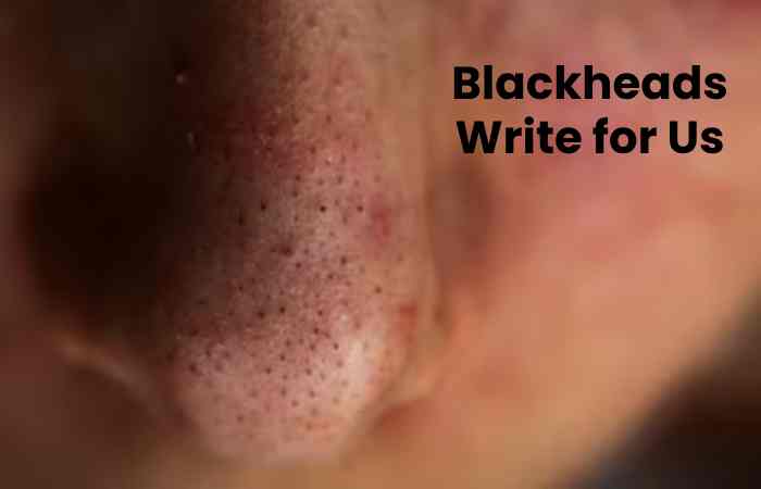 Blackheads Write for Us